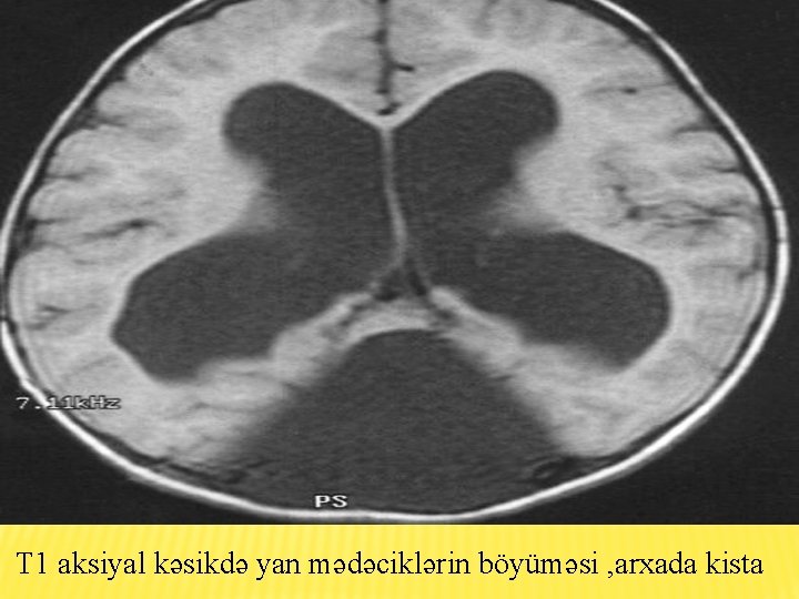 T 1 aksiyal kəsikdə yan mədəciklərin böyüməsi , arxada kista 