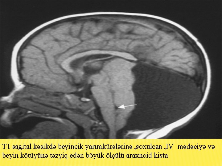 T 1 sagital kəsikdə beyincik yarımkürələrinə , soxulcan , IV mədəciyə və beyin kötüyünə