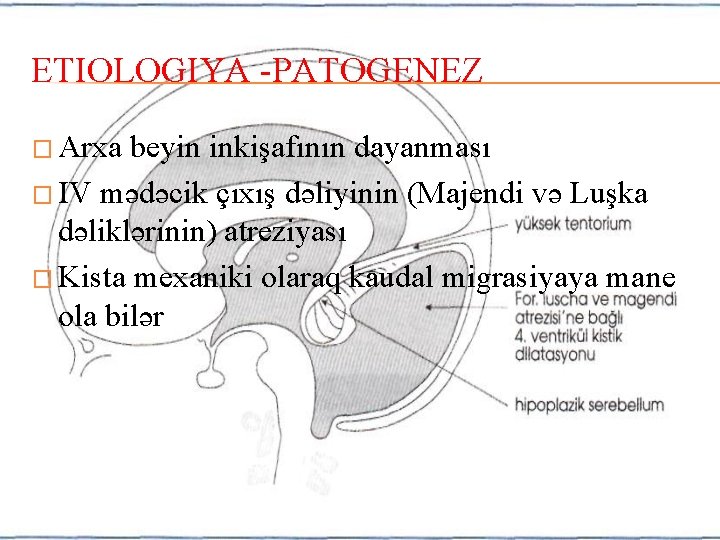 ETIOLOGIYA -PATOGENEZ � Arxa beyin inkişafının dayanması � IV mədəcik çıxış dəliyinin (Majendi və