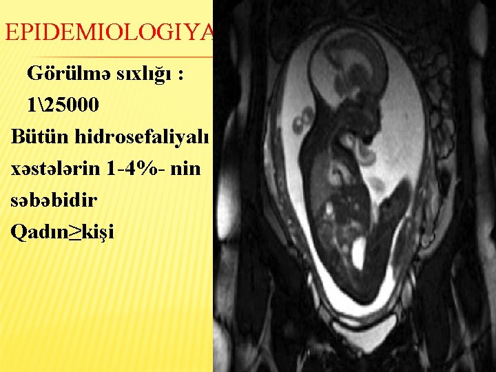 EPIDEMIOLOGIYASI Görülmə sıxlığı : 125000 Bütün hidrosefaliyalı xəstələrin 1 -4%- nin səbəbidir Qadın≥kişi 