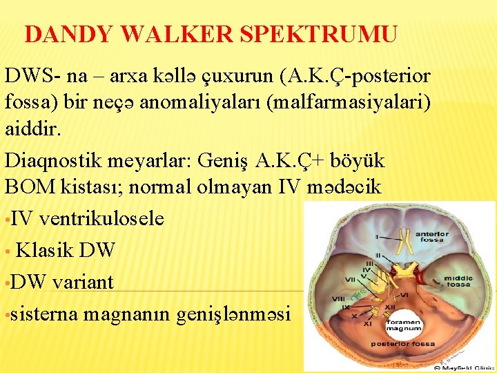 DANDY WALKER SPEKTRUMU DWS- na – arxa kəllə çuxurun (A. K. Ç-posterior fossa) bir