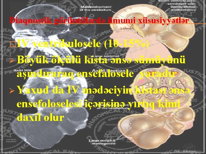 Diaqnostik görüntülərdə ümumi xüsusiyyətlər �IV ventrikulosele (10 -15%) Ø Böyük ölçülü kista ənsə sümüyünü