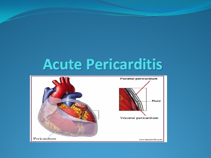 Acute Pericarditis 