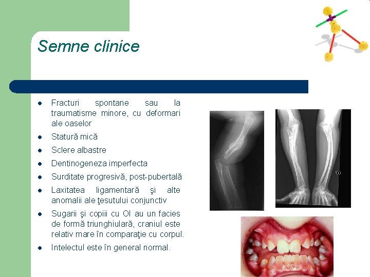 Semne clinice l Fracturi spontane sau la traumatisme minore, cu deformari ale oaselor l