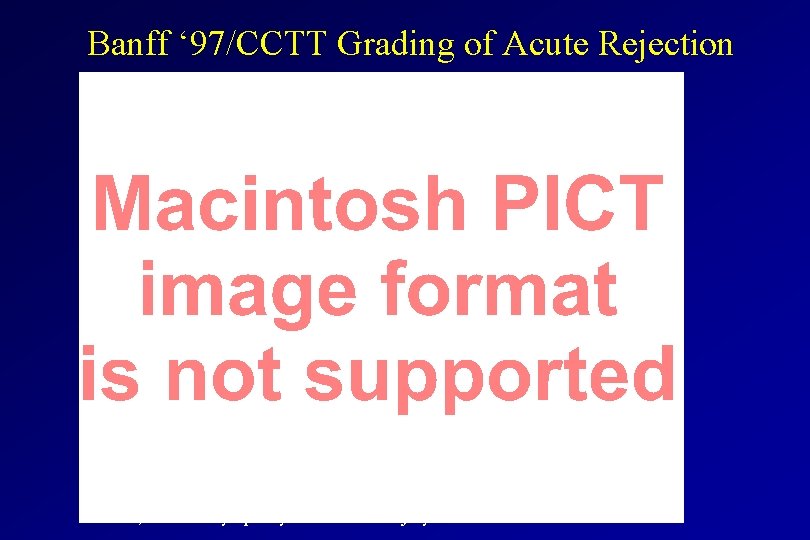 Banff ‘ 97/CCTT Grading of Acute Rejection * with at least i 1 and