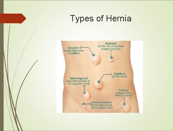 Types of Hernia Types of Hernia