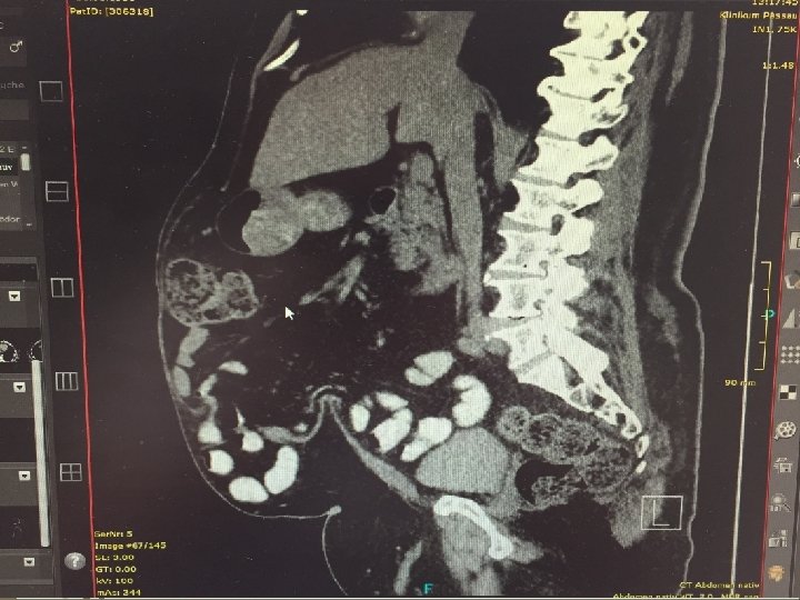 Hernia in cicatrice Hernia in cicatrice