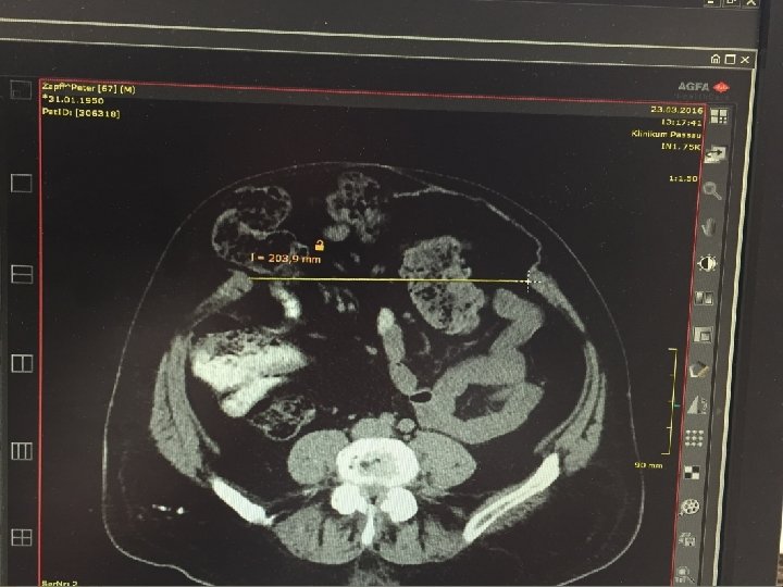Hernia in cicatrice Hernia in cicatrice