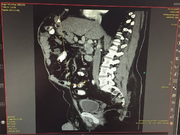 Hernia in cicatrice Hernia in cicatrice