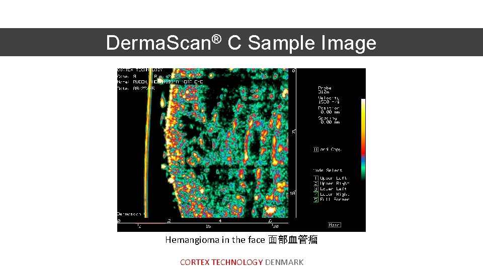Derma. Scan® C Sample Image Hemangioma in the face 面部血管瘤 CORTEX TECHNOLOGY DENMARK 