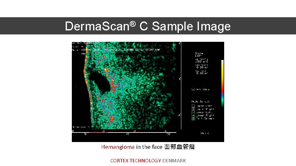 Derma. Scan® C Sample Image Hemangioma in the face 面部血管瘤 CORTEX TECHNOLOGY DENMARK 