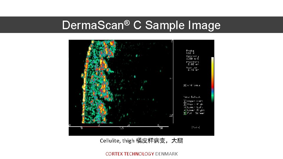 Derma. Scan® C Sample Image Cellulite, thigh 橘皮样病变，大腿 CORTEX TECHNOLOGY DENMARK 