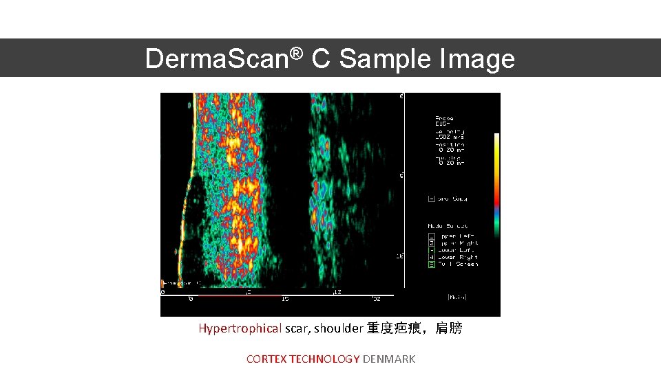 Derma. Scan® C Sample Image Hypertrophical scar, shoulder 重度疤痕，肩膀 CORTEX TECHNOLOGY DENMARK 