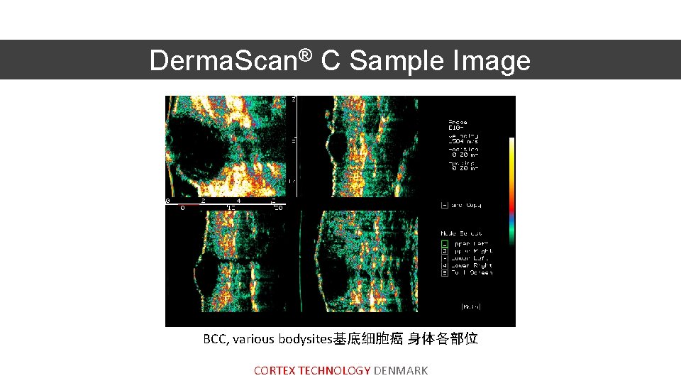Derma. Scan® C Sample Image BCC, various bodysites基底细胞癌 身体各部位 CORTEX TECHNOLOGY DENMARK 