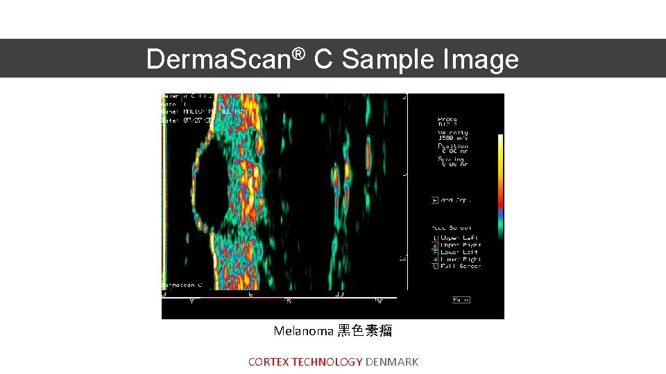 Derma. Scan® C Sample Image Melanoma 黑色素瘤 CORTEX TECHNOLOGY DENMARK 