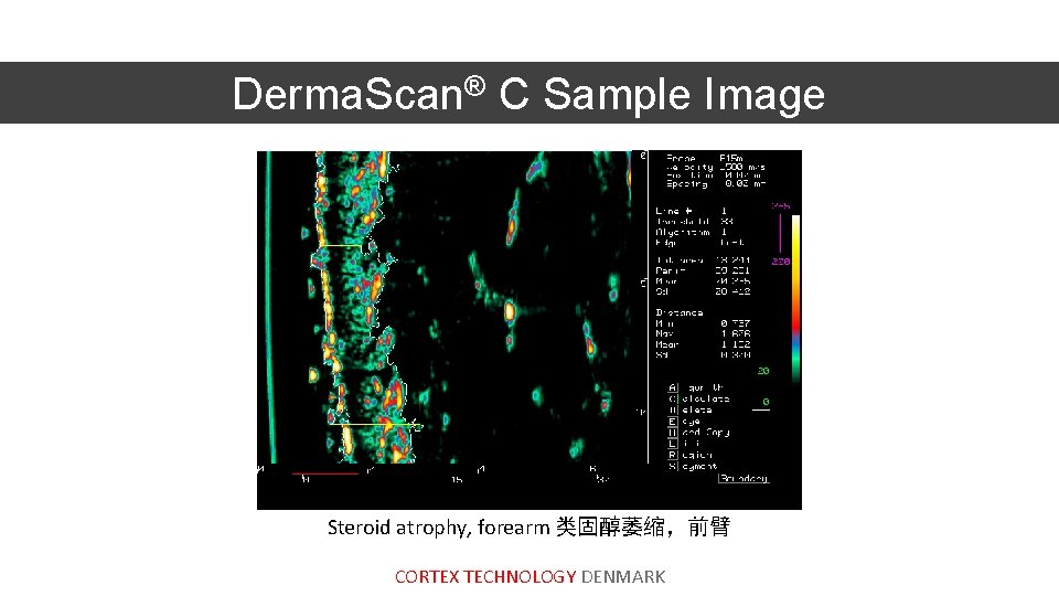 Derma. Scan® C Sample Image Steroid atrophy, forearm 类固醇萎缩，前臂 CORTEX TECHNOLOGY DENMARK 
