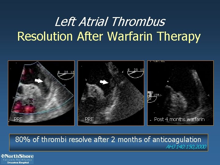 Left Atrial Thrombus Resolution After Warfarin Therapy PRE Post 4 months warfarin 80% of