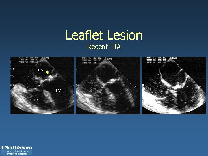 Leaflet Lesion Recent TIA 