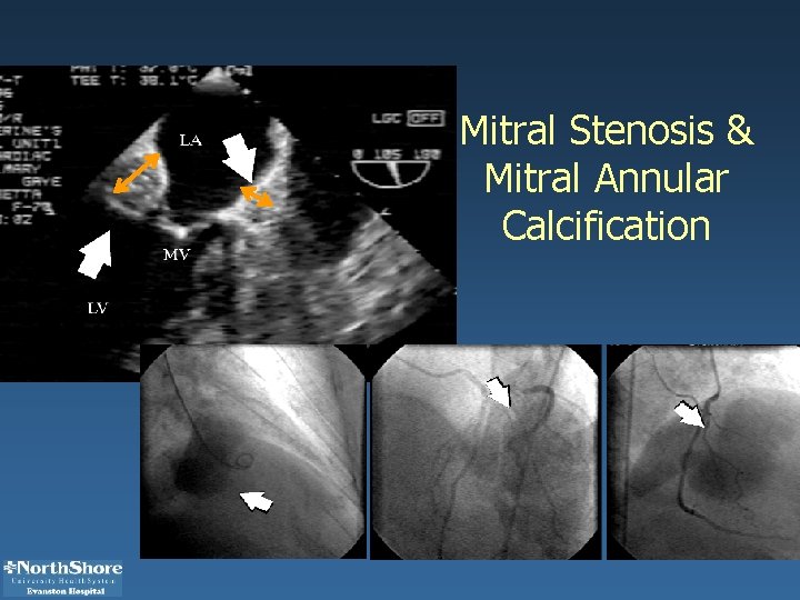 Mitral Stenosis & Mitral Annular Calcification 