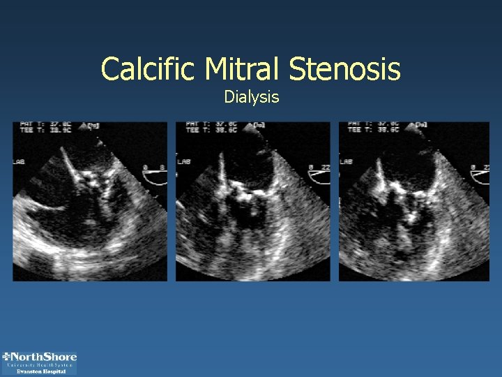 Calcific Mitral Stenosis Dialysis 