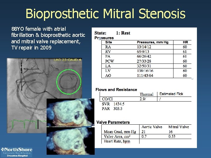 Bioprosthetic Mitral Stenosis 88 YO female with atrial fibrillation & bioprosthetic aortic and mitral