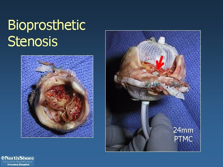 Bioprosthetic Stenosis 24 mm PTMC 