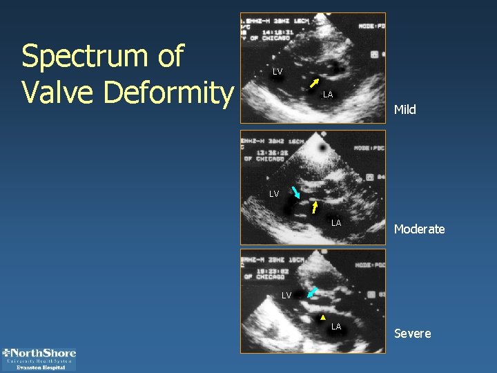Spectrum of Valve Deformity LV LA Mild LV LA Moderate LA Severe LV 