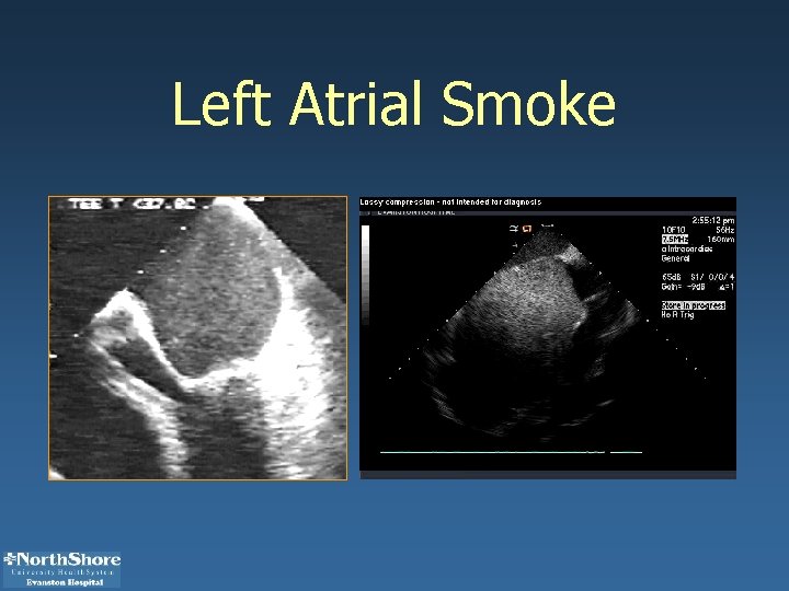 Left Atrial Smoke 