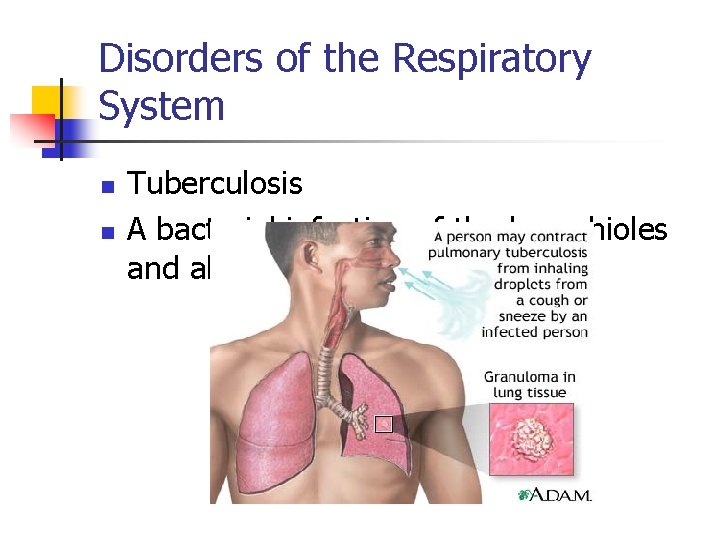 Disorders of the Respiratory System n n Tuberculosis A bacterial infection of the bronchioles