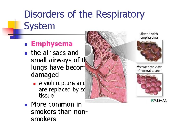 Disorders of the Respiratory System n n Emphysema the air sacs and small airways