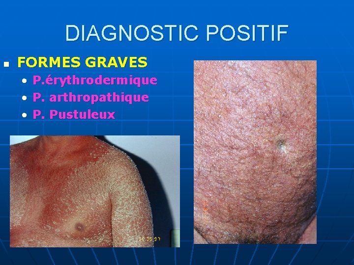 DIAGNOSTIC POSITIF n FORMES GRAVES • • • P. érythrodermique P. arthropathique P. Pustuleux