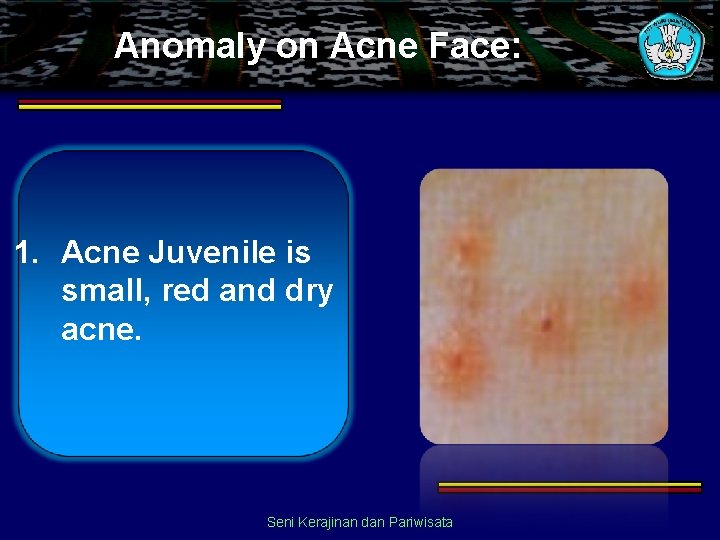 Anomaly on Acne Face: 1. Acne Juvenile is small, red and dry acne. Seni