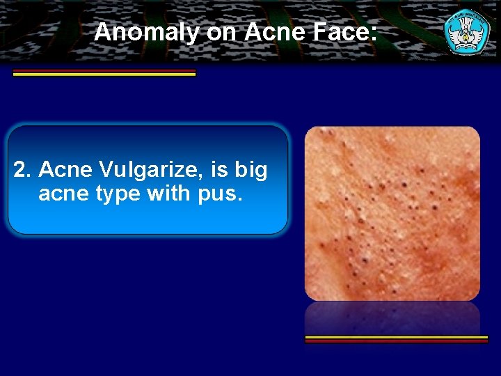 Anomaly on Acne Face: 2. Acne Vulgarize, is big acne type with pus. 