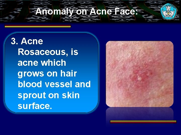 Anomaly on Acne Face: 3. Acne Rosaceous, is acne which grows on hair blood