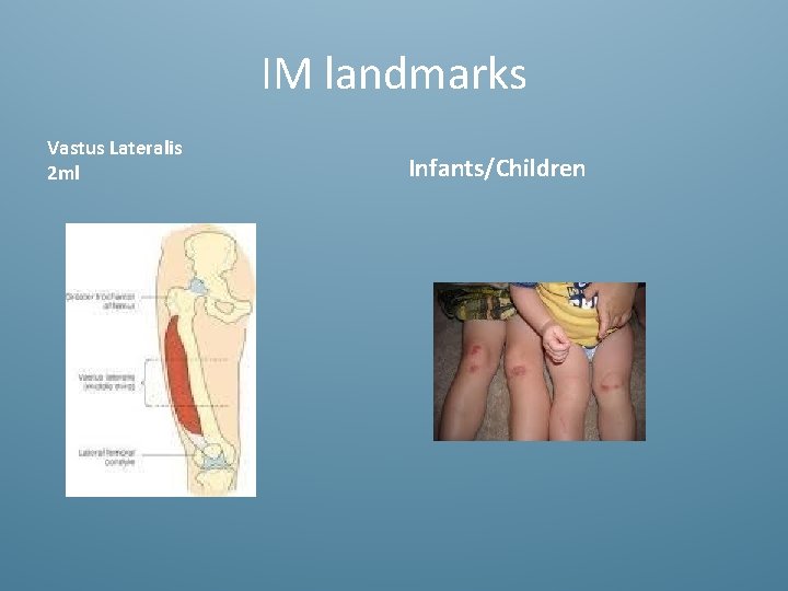 IM landmarks Vastus Lateralis 2 ml Infants/Children 