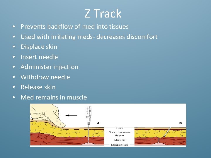 Z Track • • Prevents backflow of med into tissues Used with irritating meds-