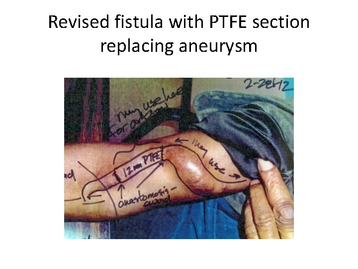 Revised fistula with PTFE section replacing aneurysm 