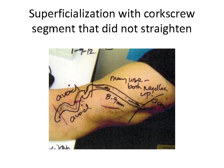 Superficialization with corkscrew segment that did not straighten 