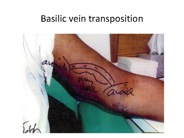 Basilic vein transposition 