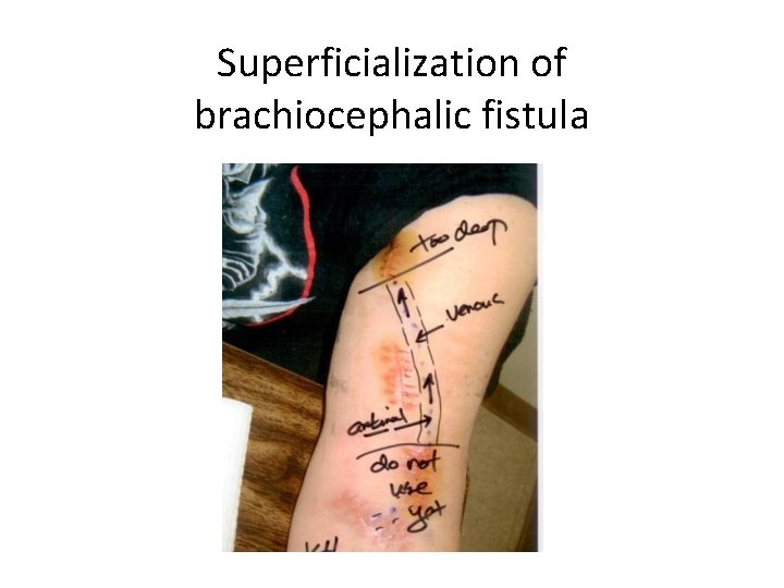 Superficialization of brachiocephalic fistula 
