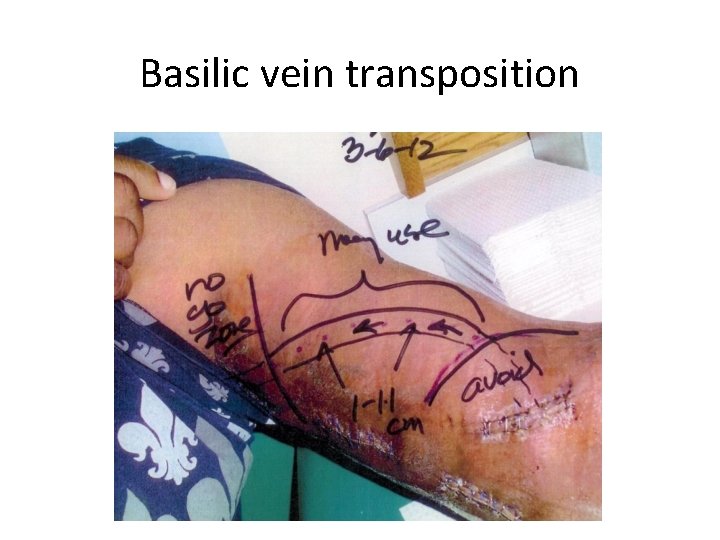 Basilic vein transposition 