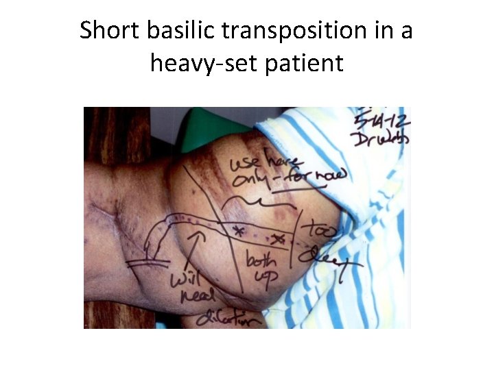 Short basilic transposition in a heavy-set patient 