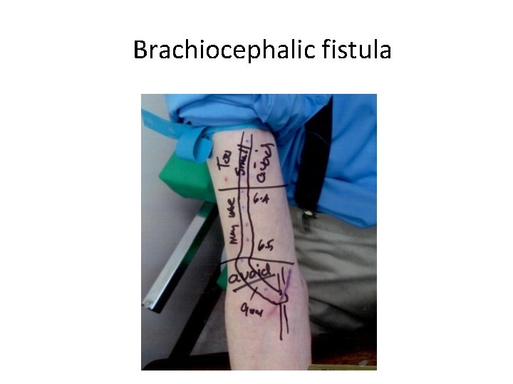 Brachiocephalic fistula 