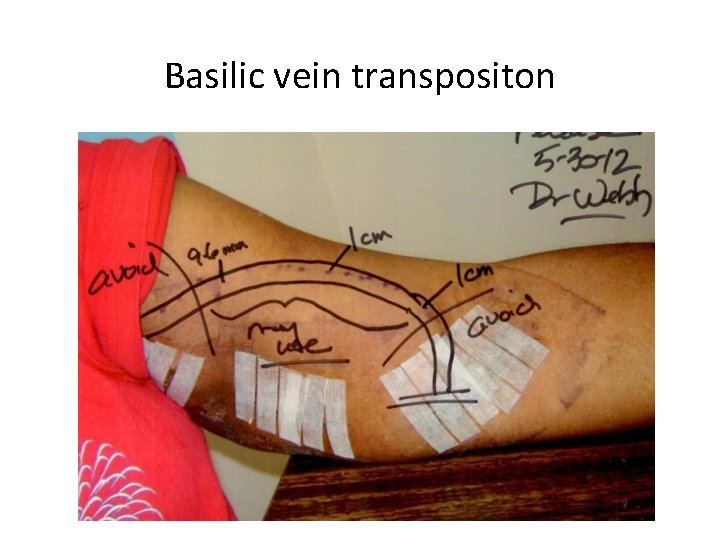Basilic vein transpositon 