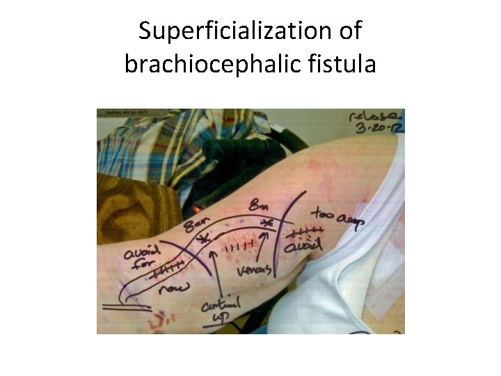 Superficialization of brachiocephalic fistula 