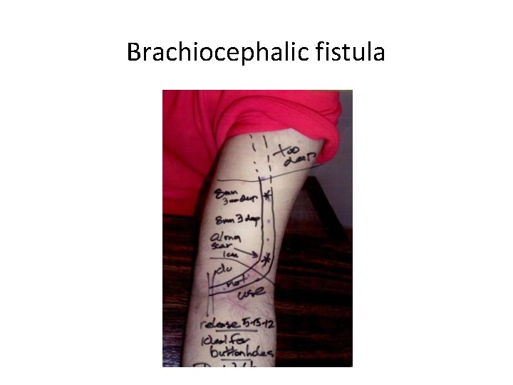 Brachiocephalic fistula 
