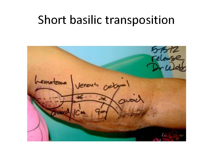 Short basilic transposition 