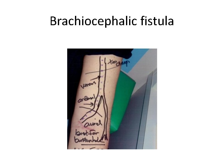 Brachiocephalic fistula 