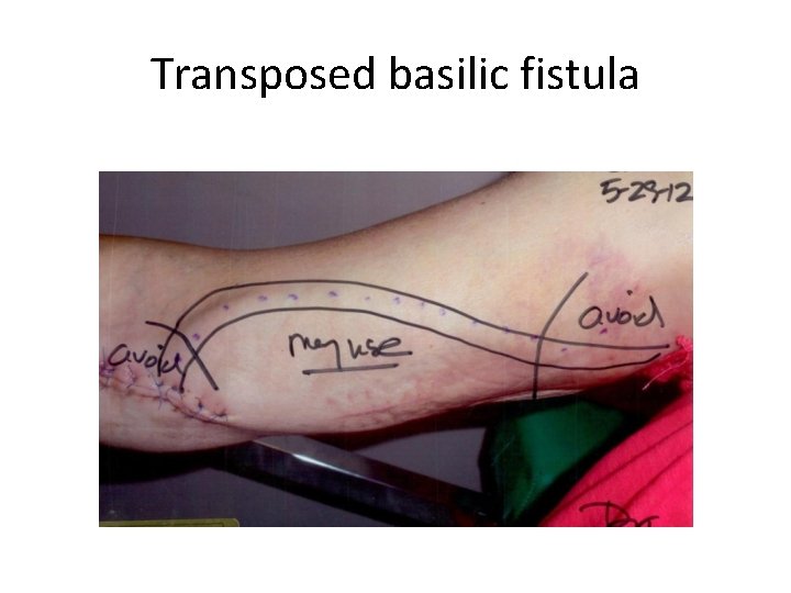 Transposed basilic fistula 
