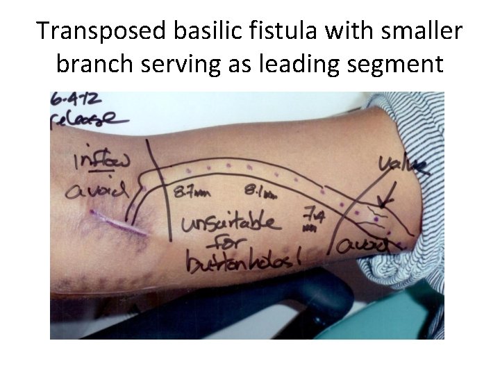 Transposed basilic fistula with smaller branch serving as leading segment 